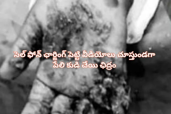Cell Phone Exploded: సెల్ ఫోన్ ఛార్జింగ్ పెట్టి వీడియోలు చూస్తున్న బాలిక.. చేతిలో పేలి కుడి చేయి ఛిద్రం..